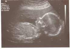 Picture of me as a fetus